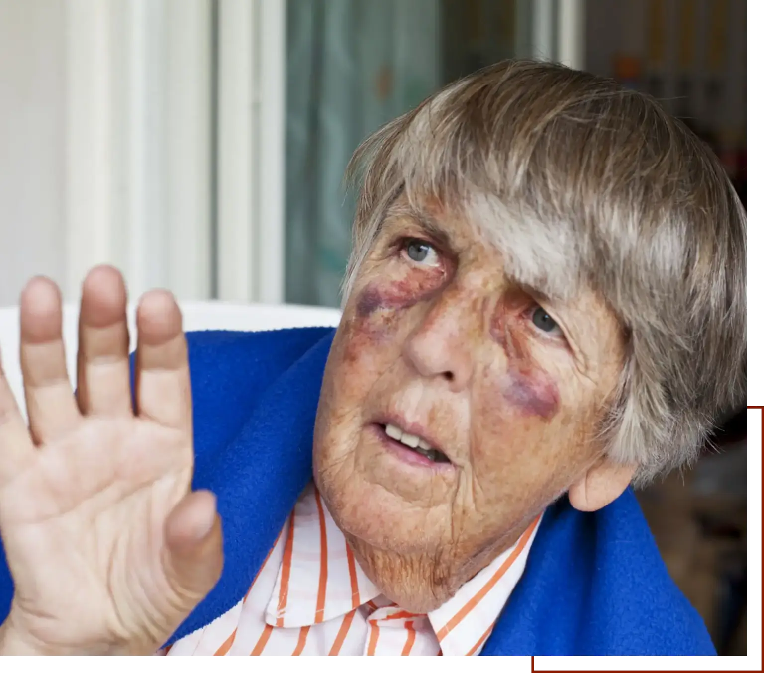 Woman with bruises on her face and hand, set against a blurred background